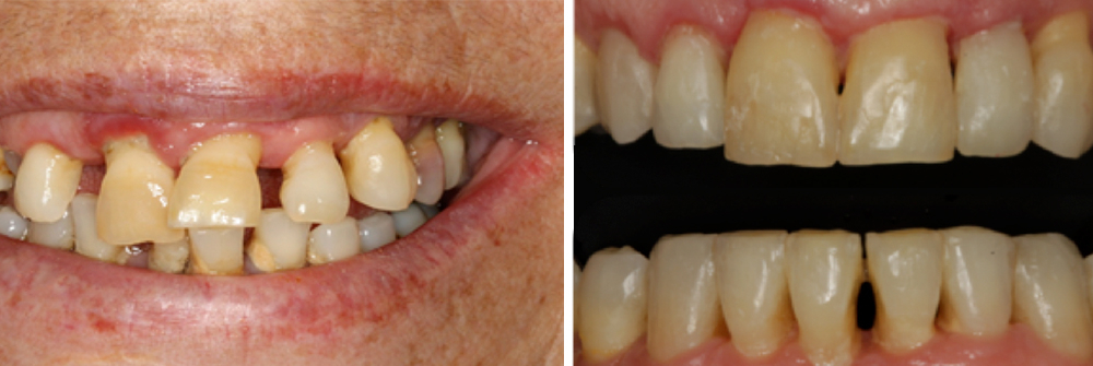 Tratamiento multidisciplinar de un paciente con Periodontitis avanzada generalizada