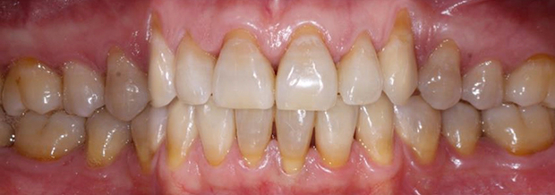 Tratamiento de Recesiones Gingivales Clase III de Miller mediante técnica de túnel