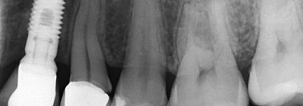 Terapia mucogingival en implantes: corrección de las secuelas mucosas de la periimplantitis