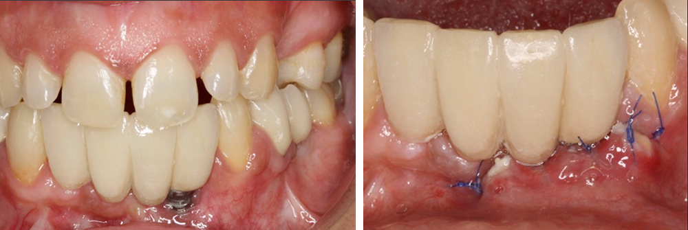 Injerto de tejido conectivo en el tratamiento de defectos mucosos asociados a implantes, a propósito de un caso