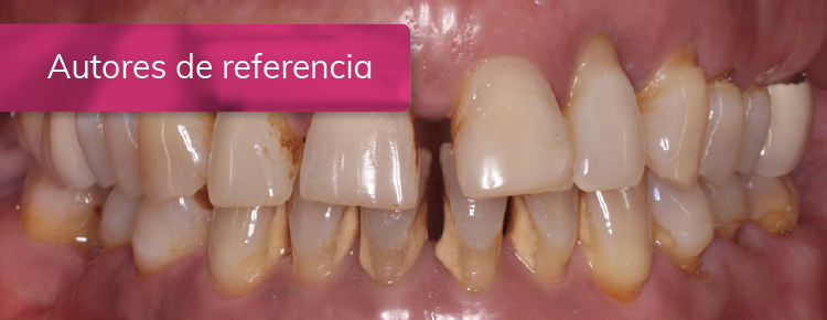 TRATAMIENTO DE PACIENTE CON PERIODONTITIS ESTADIO IV GRADO C